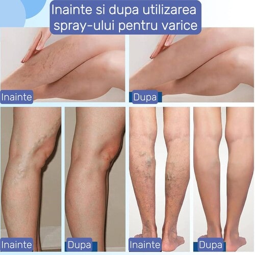Spray natural pentru varice